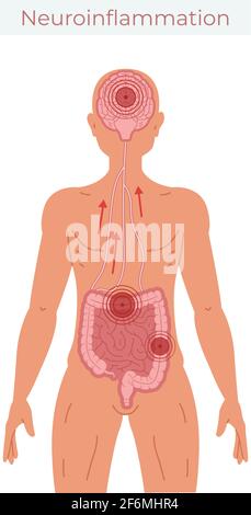 Una cattiva salute intestinale porta a un'illustrazione vettoriale della neuroinfiammazione. Illustrazione Vettoriale