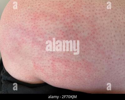 Pelle chiazzata calore eruzione cutanea orticaria reazione allergica al ginocchio primo piano immagine di riferimento di blotchy chiazzata pelle rossa eritema ab igne noto anche come EAI Foto Stock