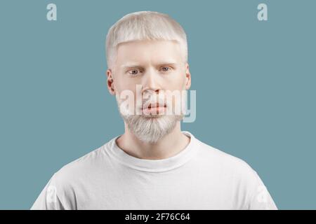 Ritratto dell'uomo albino in t-shirt in posa su sfondo turchese dello studio. Aspetto insolito, concetto di anomalia della pelle Foto Stock