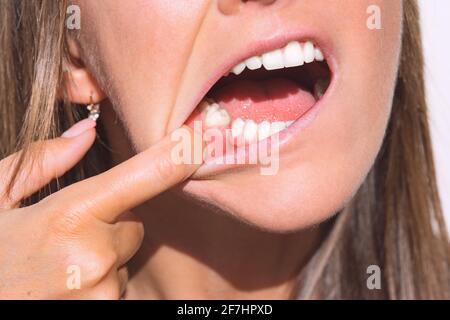 Giovane donna che mostra la bocca senza dente sulla mascella inferiore. Dente mancante, nessun dente. In attesa di un impianto dopo l'estrazione del dente Foto Stock