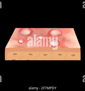 Cisti acne. Furuncle Acne sulla pelle cisti e pimples. Malattie infiammatorie dermatologiche e cosmetiche sulla pelle del viso. Infografica Illustrazione Vettoriale