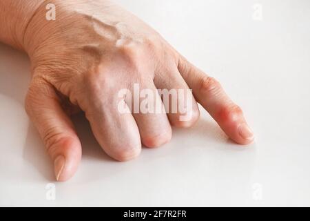 La mano di una donna anziana con rheumatism delle mani e un cambiamento nelle articolazioni primo piano. Foto Stock