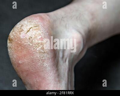Pelle danneggiata sul tallone della gamba dell'uomo. Crepe e spellature. Foto Stock