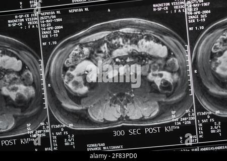 Imaging di risonanza magnetica, MRI, tomografia computerizzata, immagine radiologica. Area addominale in sezione trasversale Area del bacino ​​the con reni infetti da tum Foto Stock