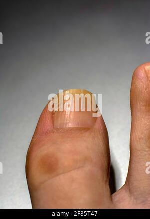 Τoenail con infezione fungina lieve Foto Stock