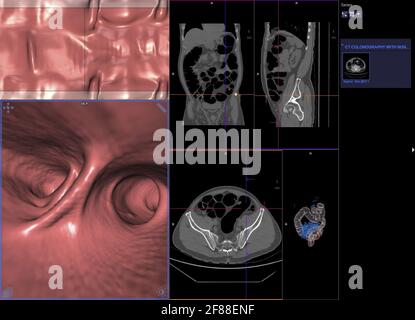 Colonografia TC o scansione TC della vista assiale del colon rispetto alla vista coronale e immagine di rendering 3D sullo schermo per la diagnosi del cancro dell'intestino crasso. Foto Stock