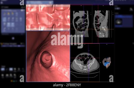 Colonografia TC o scansione TC della vista assiale del colon rispetto alla vista coronale e immagine di rendering 3D sullo schermo per la diagnosi del cancro dell'intestino crasso. Foto Stock