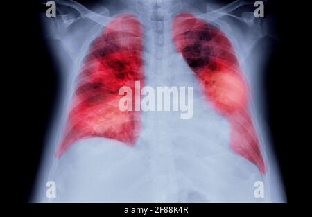 Immagine radiografica o radiologica del torace del torace o del polmone umano ( zona rossa ) che mostra tubercolosi (TB) e virus della corona 2019. Foto Stock