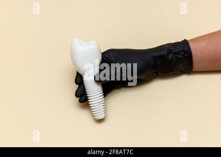 La mano femminile in un guanto medico nero tiene un impianto dentale su uno sfondo beige. Modello di impianto dentale del dente artificiale. Concetto di odontoiatria e. Foto Stock