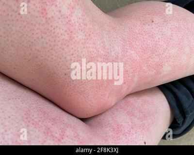 Pelle chiazzata calore eruzione cutanea orticaria reazione allergica al ginocchio primo piano immagine di riferimento di blotchy chiazzata pelle rossa eritema ab igne noto anche come EAI Foto Stock