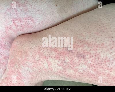 Pelle chiazzata calore eruzione cutanea orticaria reazione allergica al ginocchio primo piano immagine di riferimento di blotchy chiazzata pelle rossa eritema ab igne noto anche come EAI Foto Stock