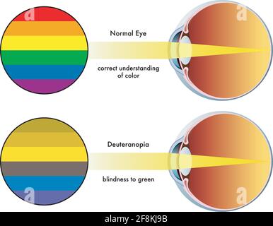 L'illustrazione medica mostra come i colori sono percepiti da un occhio sano e da uno influenzato da deuteranopia. Illustrazione Vettoriale