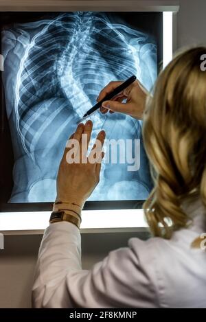 Bionda medico femminile che guarda un paziente radiografia. Specialista di scoliosi medico effettuare misurazioni ai raggi X dei pazienti Foto Stock