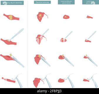 Illustrazione piatta vettoriale dell'intervento chirurgico per rimuovere le pietre dalle ghiandole salivari parotide, submandibolari e sublinguali. Illustrazione Vettoriale