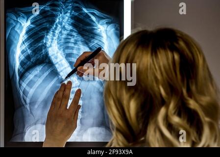 Bionda medico femminile che guarda un paziente radiografia. Specialista di scoliosi medico effettuare misurazioni ai raggi X dei pazienti Foto Stock