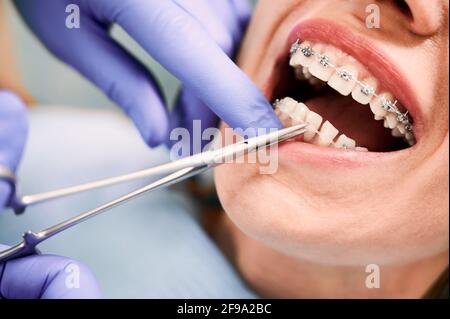 Primo piano delle mani ortodontiste in guanti blu con pinzette dentali mentre si mette il filo di legatura sui denti della paziente. Donna con bretelle metalliche sui denti che riceve un trattamento ortodontico in clinica. Foto Stock