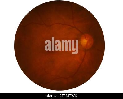 Retina del diabete , retinopatia diabetica,foto Medicina Retina anormale isolato su sfondo bianco.salvato con percorso di ritaglio Foto Stock