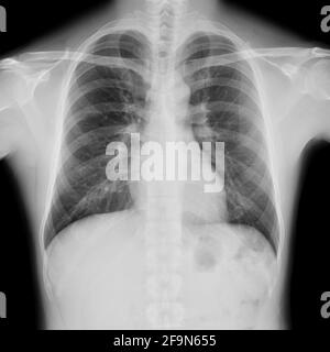 Pellicola radiografica del torace maschio normale Foto Stock