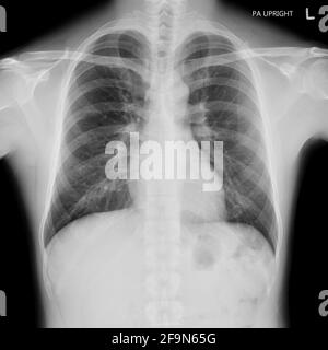 Pellicola radiografica del torace maschio normale Foto Stock