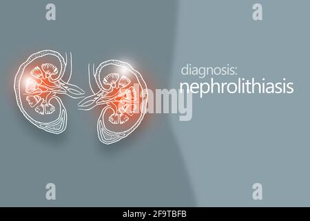 Nefrolitiasi calcoli renali malattia o urolitiasi. Calcoli renali o pietre che bloccano il tratto urinario.modello di disegno di stile minimalistico Foto Stock