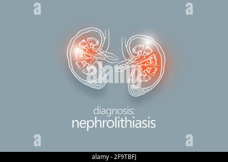 Nefrolitiasi calcoli renali malattia o urolitiasi. Calcoli renali o pietre che bloccano il tratto urinario.modello di disegno di stile minimalistico Foto Stock