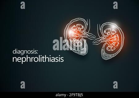 Nefrolitiasi calcoli renali malattia o urolitiasi. Calcoli renali o pietre che bloccano il tratto urinario.modello di disegno di stile minimalistico Foto Stock