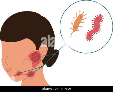 Una donna con infiammazione batterica delle ghiandole salivari. Illustrazione vettoriale della sialolitiasi. Illustrazione Vettoriale