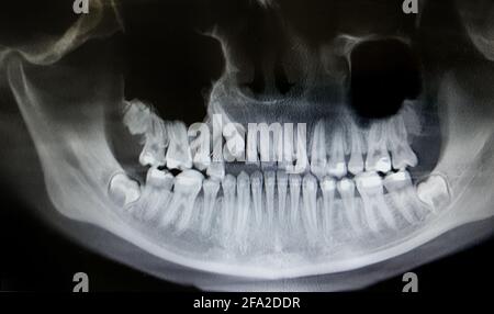 Radiografia dentale con bretelle. Ortopantomografia, OPG X-ray DR digitale per denti adolescenti Foto Stock