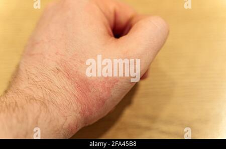 Allergia sulla mano maschile. Irritazioni rosse. Foto Stock