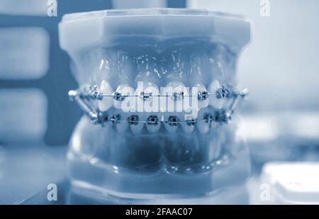 Bretelle su denti artificiali mascelle da vicino, odontoiatria dentale Foto Stock