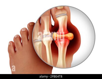 Gotta del piede e malattia dolorosa dell'artrite dei piedi come i piedi si avvicinano con un dito del piede umano come un simbolo di iperuricemia di trattamento e di diagnosi del dolore cronico. Foto Stock