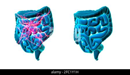 Intestino sano e malsano, illustrazione concettuale Foto Stock