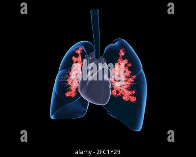 Infezione polmonare virale, illustrazione Foto Stock