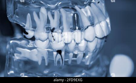 Modello trasparente di denti umani con impianti da primo piano. Foto Stock