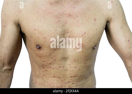 Primo piano UN uomo e papule rash nel corpo su sfondo bianco.Saved con ritaglio percorso. Foto Stock