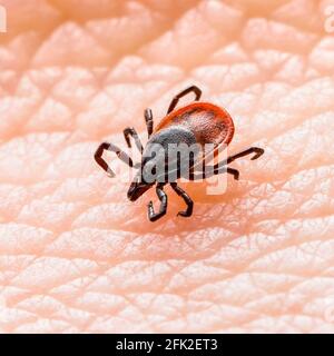 Encefalite infettiva Ixodes Scapularis o Persulcatus Deer Tick Insect sulla pelle. Encefalite virus o malattia di Lyme borreliosi infetta Ixodes Tick Foto Stock