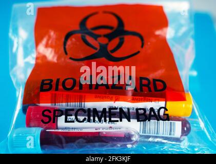 Covid pazienti campioni di sangue in un sacchetto di rifiuti medici. Pericolo medico Foto Stock