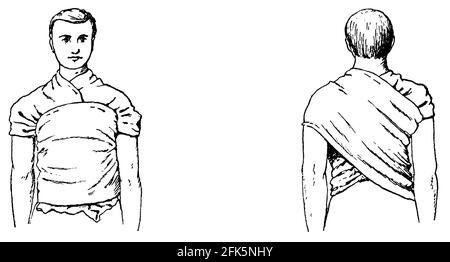 Copertura delle spalle e parte centrale del corpo del paziente. Vista anteriore e posteriore. Illustrazione del 19 ° secolo. Germania. Sfondo bianco. Foto Stock