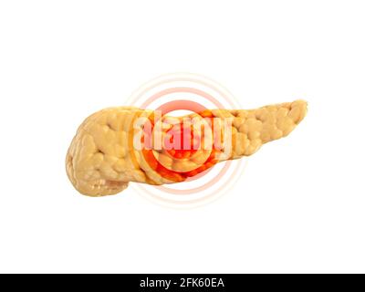 Malattia o concetto di dolore del pancreas umano isolato su bianco con il segno rosso di dolore su di esso. illustrazione 3d Foto Stock