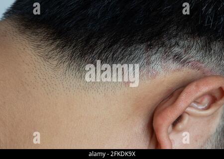 Chiuso di tigna (tinea) sulla testa di uomo asiatico (dermatiti) Foto Stock