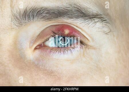 Chalazion sugli occhi. Colpo di closeup dell'occhio dell'uomo con infezione delle palpebre Foto Stock