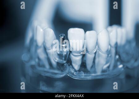 Modello trasparente di denti umani con impianti da primo piano. Foto Stock