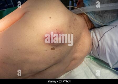 un grande ascesso cresce sulla schiena di un paziente Foto Stock