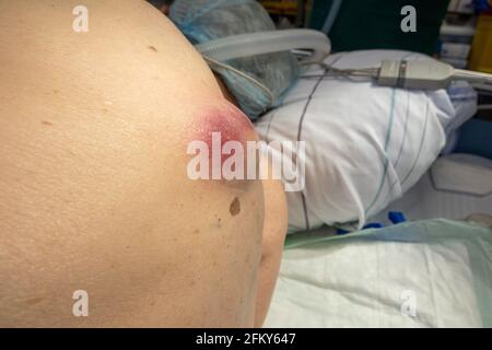 un grande ascesso cresce sulla schiena di un paziente Foto Stock