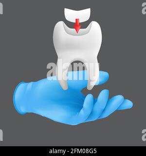 Mano dentista che indossa guanto chirurgico protettivo blu che tiene un modello ceramico del dente. illustrazione vettoriale 3d realistica del concetto di otturamento dentale Illustrazione Vettoriale