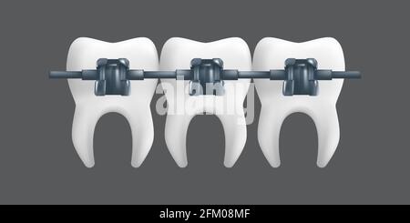 Denti con bretelle metalliche. Concetto di trattamento ortodontico. rappresentazione vettoriale realistica in 3d di un modello dentistico ceramico isolato su sfondo grigio Illustrazione Vettoriale