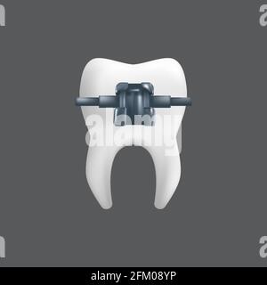 Un dente con un rinforzo metallico. Concetto di trattamento ortodontico. rappresentazione vettoriale realistica in 3d di un modello dentistico ceramico isolato su sfondo grigio Illustrazione Vettoriale