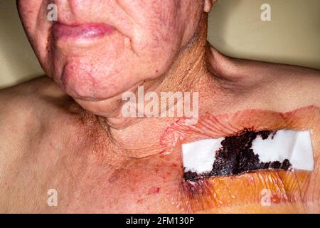 Paziente che si sta riprendendo da un intervento chirurgico con pacemaker cardiaco Foto Stock