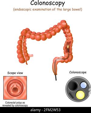 colonoscopia nell'intestino crasso. Primo piano del colonoscopio e del polipo colorettale. Sezione trasversale di un colon. Illustrazione vettoriale Illustrazione Vettoriale