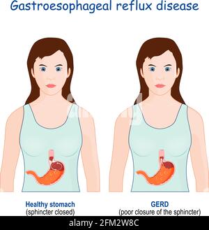 Bruciore di stomaco e malattia da reflusso gastroesofageo. Donna con stomaco sano, e GERD (scarsa chiusura dello sfintere Illustrazione Vettoriale